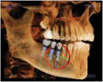 CBCT3