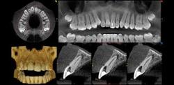CBCT