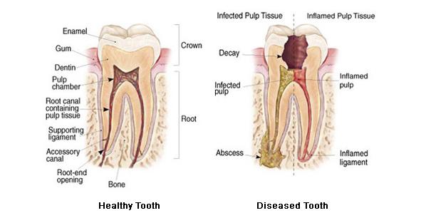 healthy diseased tooth Fotor